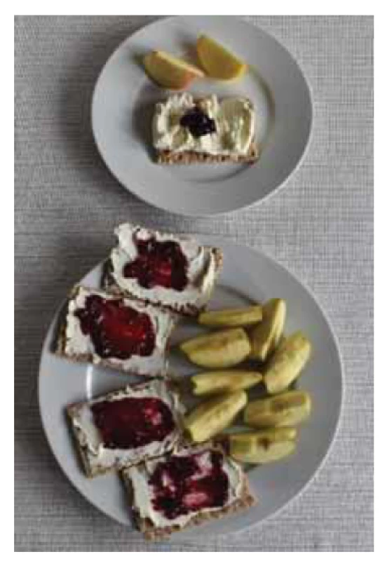 Srovnání velikosti běžné porce
a porce po bariatrickém zákroku (foto
autor).<br>
Fig. 1. Comparison of the size of a normal
portion and a portion after bariatric
surgery (photo by the author).