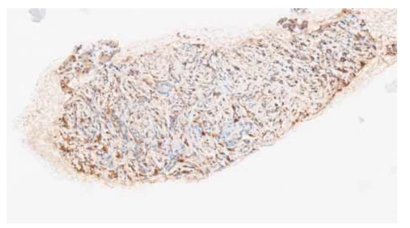 Histopatologický obraz tela pankreasu kazuistiky 1, imunohistochemické
farbenie s protilátkou proti IgG4, IgG4 pozitívne plazmocyty sú zafarbené
tmavohnedo, nález 15-20 plazmocytov/HPF (high power field, veľké
zorné pole, 40× objektív mikroskopu), histopatologický záver: pravdepodobné
(probable) histologické črty IgG4-asociovaného ochorenia/pankreatitídy.<br>
Fig. 3. Histopathological picture of the body of the pancreas in case report 1,
immunohistochemical staining with an antibody against IgG4, IgG4 positive
plasma cells are stained dark brown, finding of 15-20 plasma cells/HPF (high
power field, large field of view, 40× microscope objective), histopathological
conclusion: probable histological features of IgG4-associated disease/pancreatitis.
