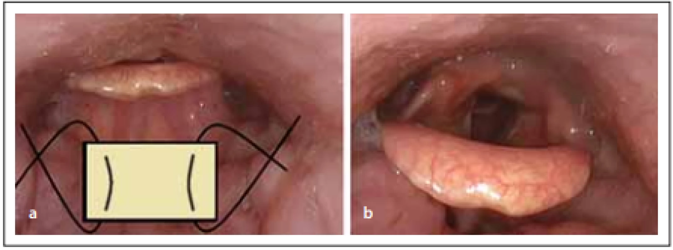 Princip epiglotopexe – (a) odstranění sliznice z oblasti lingvální plochy epiglotis 
a epiglotických valekul, fi xace epiglotis ke kořeni jazyka dvěma vstřebatelnými stehy; 
(b) stav po zhojení. <br>
Fig. 2. The principle of the epiglottopexy – (a) removal of the mucosa from the lingual 
surface of the epiglottis and epiglottic valleculae, fixation of the epiglottis to the root 
of the tongue with two absorbable sutures; (b) condition after healing.