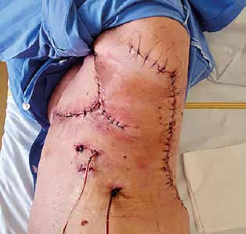 Týden po operaci<br>
Fig. 5: One week after the procedure