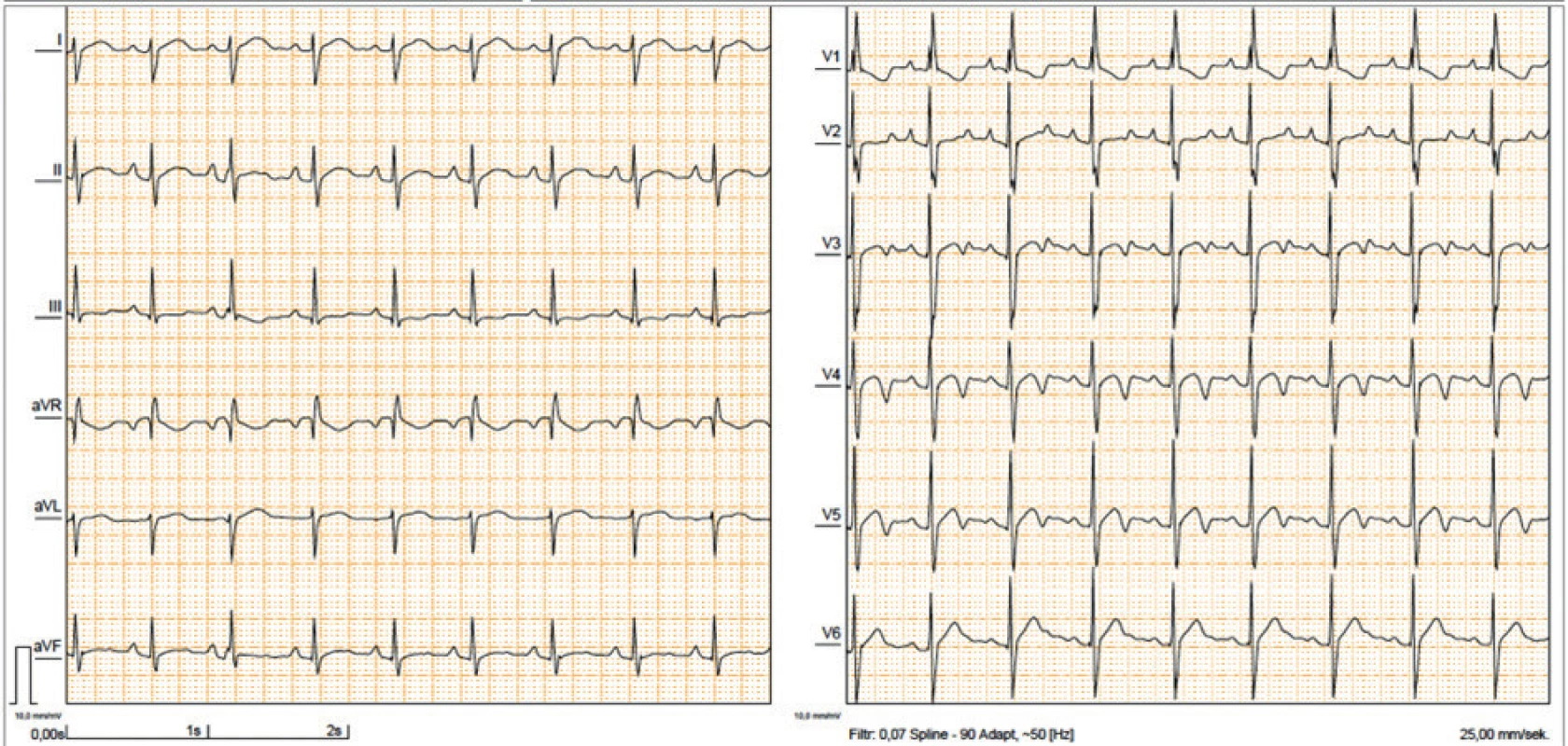 EKG 6leté pacientky s NS s výraznou rotací osy srdeční doprava nekorelující s hemodynamicky málo významnou stenózou
chlopně plicnice.<br>
Fig. 4. ECG in 6yr old girl with NS with NS showing a right axis deviation which does not correlate with the mild pulmonary valve stenosis.