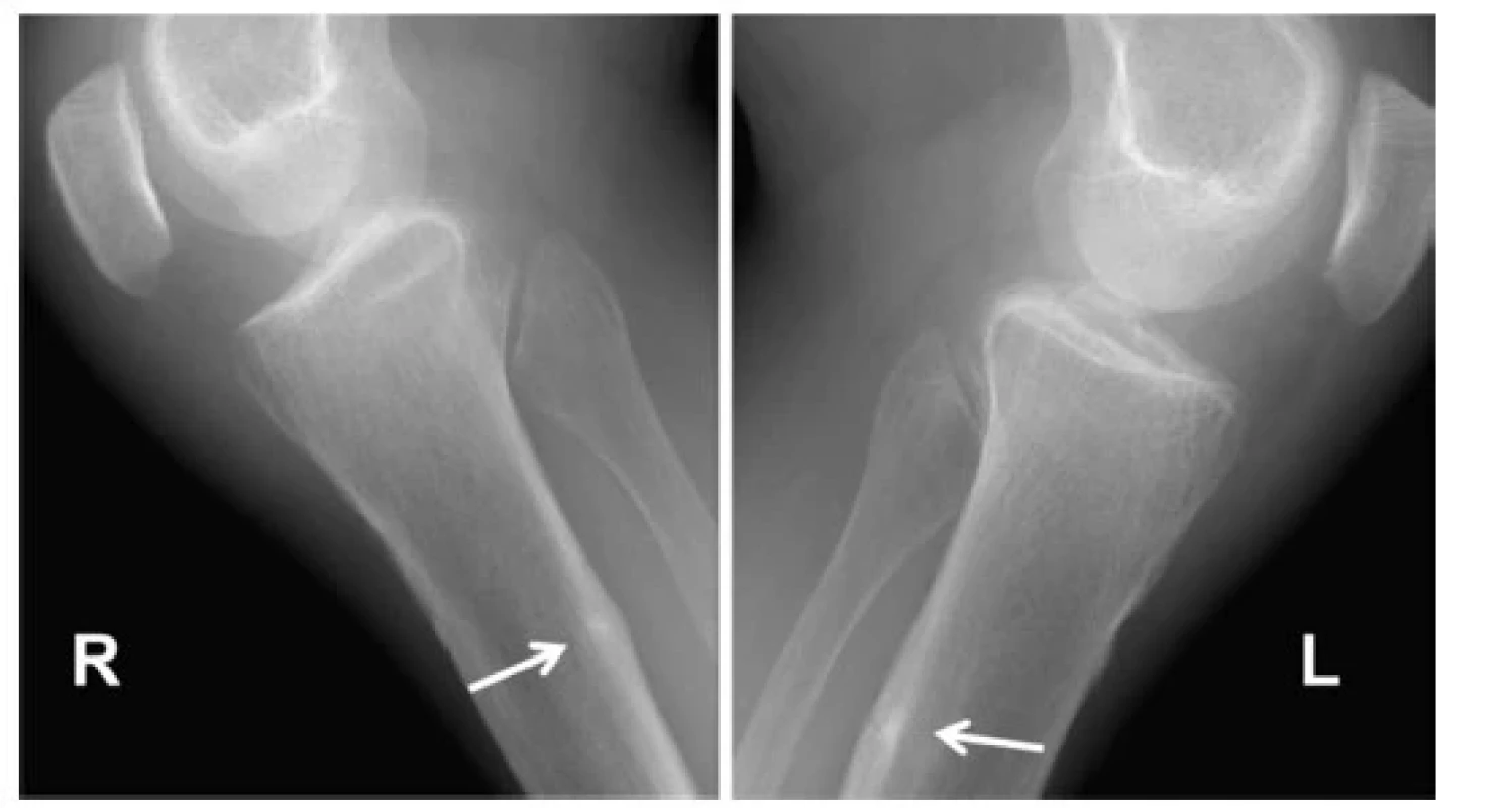 Looserovy zóny kostní přestavby obou bérců u pacienta s dekompenzovanou
Bylerovou chorobou (progresivní familiární intrahepatální
cholestáza). Chronická malabsorpce vedoucí k osteomalacii