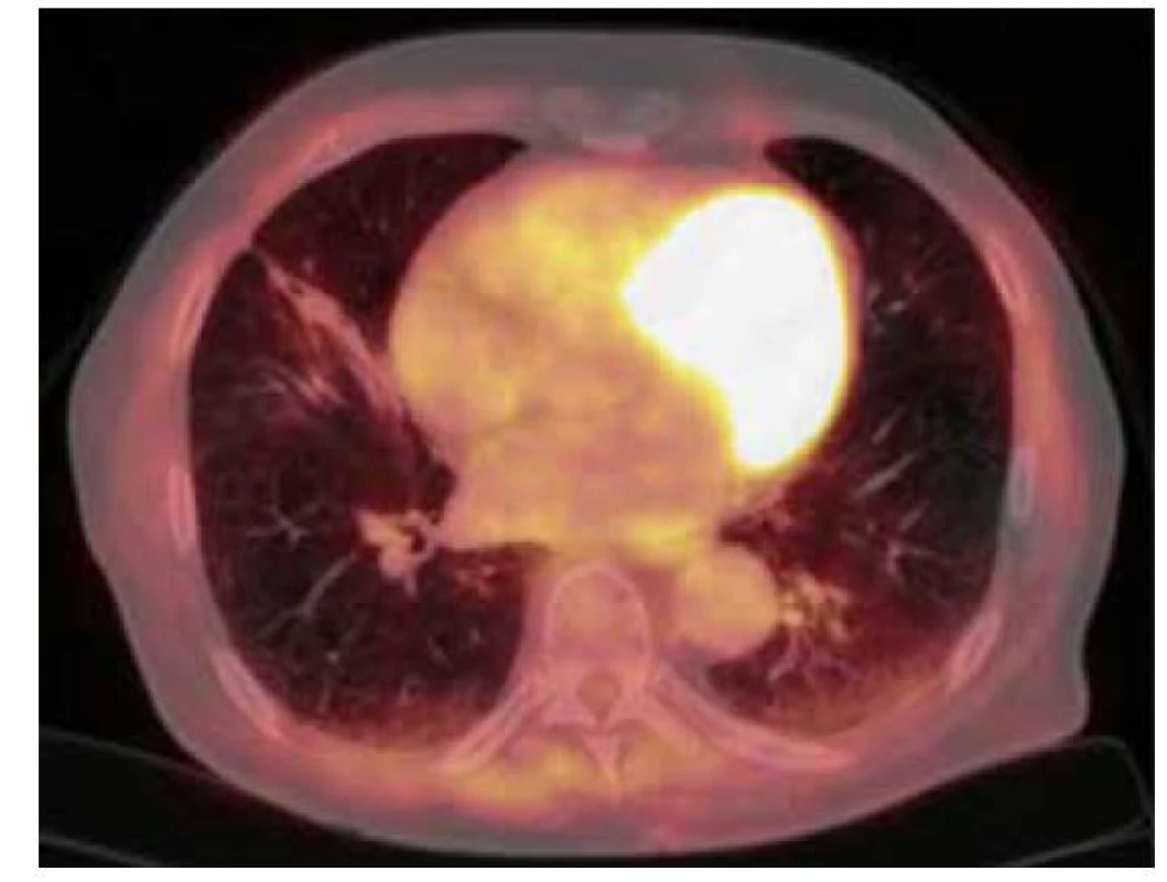 18F-FDG PET/CT vyšetření hrudníku po resekci ložiska – zobrazují
se pouze pooperační změny v pravé plíci