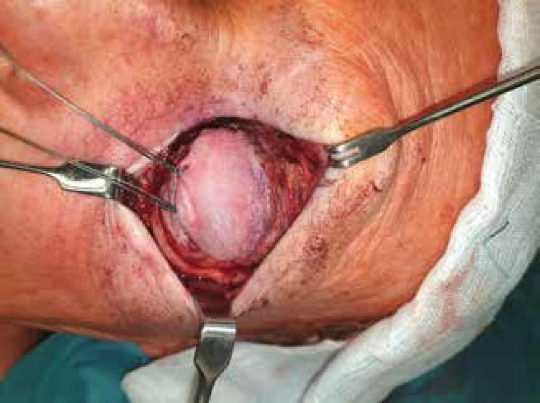 Exenteration of the orbit