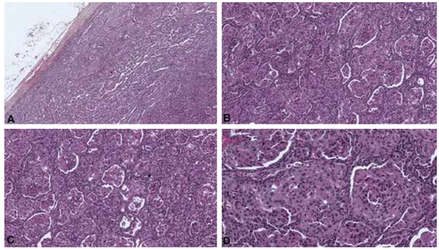 Histology of the lesion. A: the tumor is encapsulated (HES x5). B: HES x 10. C: HES x10. D: HES x20