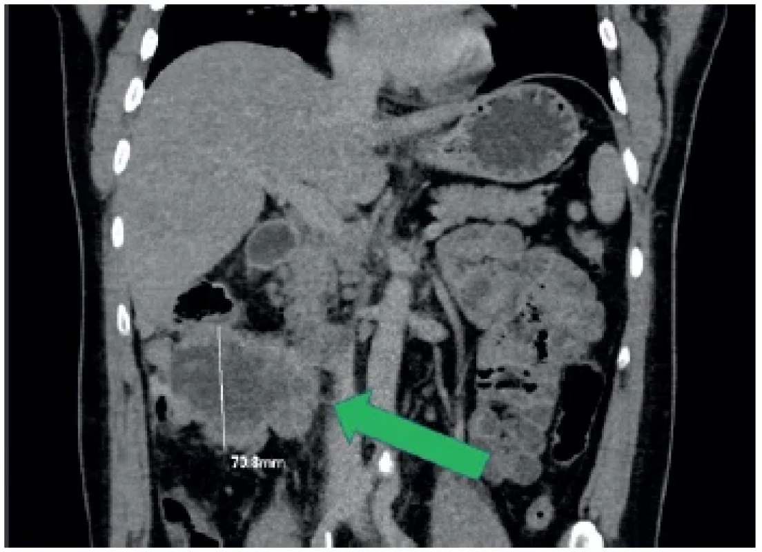 Stagingové CT vyšetření, předozadní rekonstrukce
Největší tumorozní masa je v oblasti colon ascendens (zelená
šipka). <br> 
Fig. 2. Staging CT examination, anteroposterior reconstruction
The largest tumorous mass is situated in the area of the colon
ascendens (green arrow).