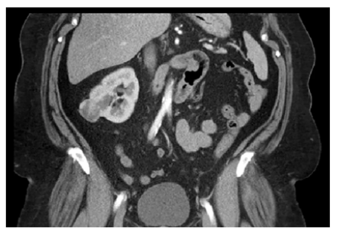 CT, koronární řez. Tumor pravé ledviny cT1a
(34 mm) RENAL skóre 5×, vlevo ageneze ledviny.
BMI 42. Řešeno laparoskopickou resekcí s nulovou
ischemií<br>
Fig. 2. CT scan, coronal plane. The tumor of the right
kidney cT1a (34 mm) RENAL score 5×, agenesis of the
left kidney. BMI 42. Laparoscopic partial nephrectomy
with zero ischemia time was performed