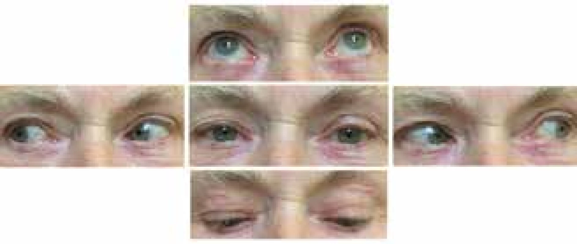 Adjustment of ophthalmoplegia
