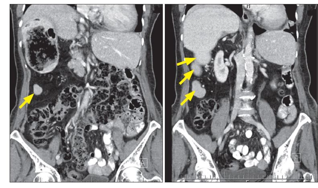 Obr. 6, 7 CT vyšetření břicha a malé pánve: inverzní uložení orgánů, fragmentovaná slezinná tkáň v pravém
hypochondriu (šipky).