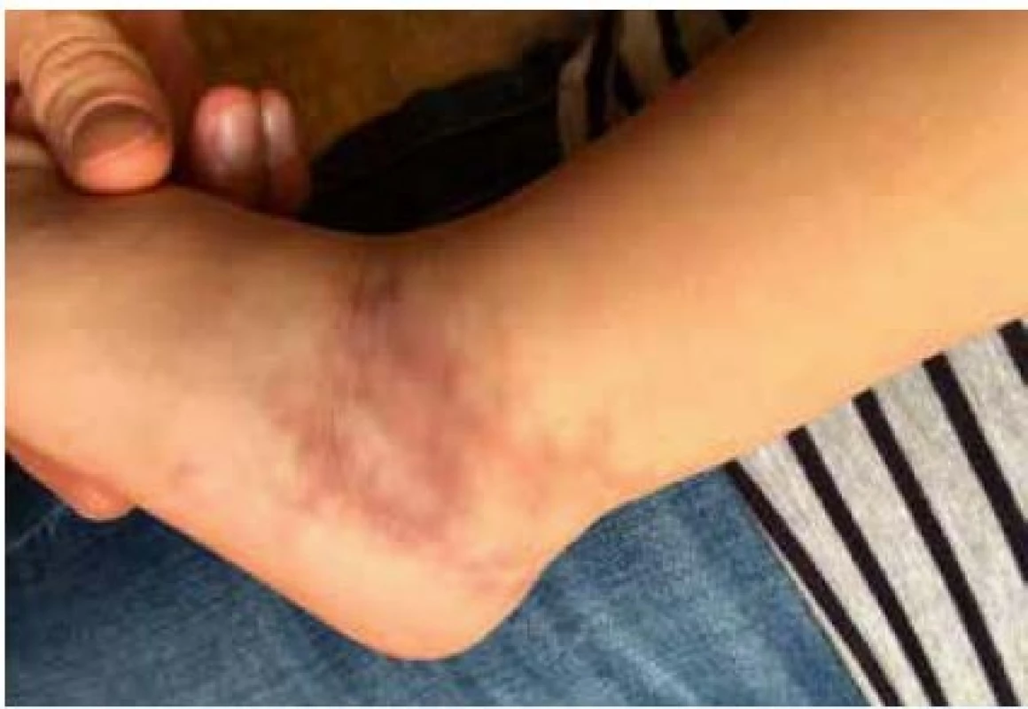Typické <i>livedo reticularis</i> u dvouleté dívky s vaskulopatií charakteru <i>polyarteritis nodosa</i>