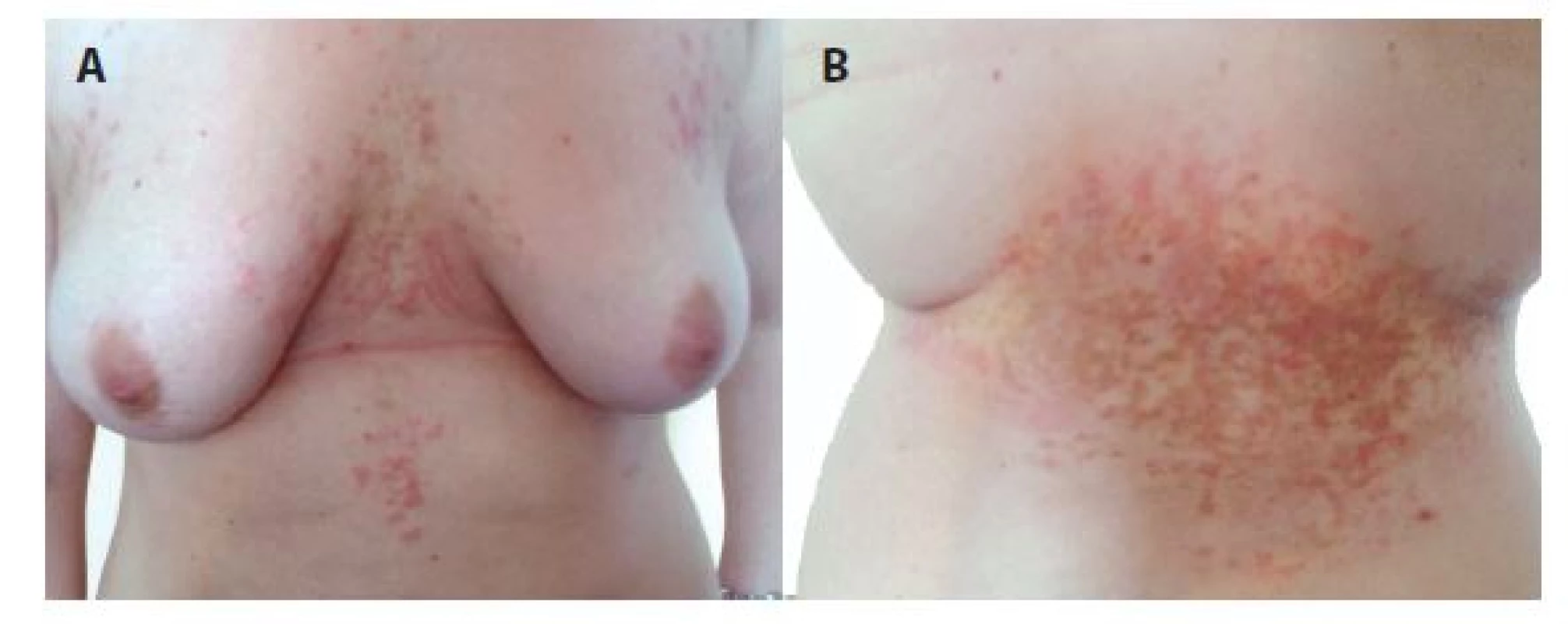 a, b. Prurigo pigmentosa
– erytematózní
retikulárně splývající makulopapuly
přecházející
v hnědé hyperpigmentace