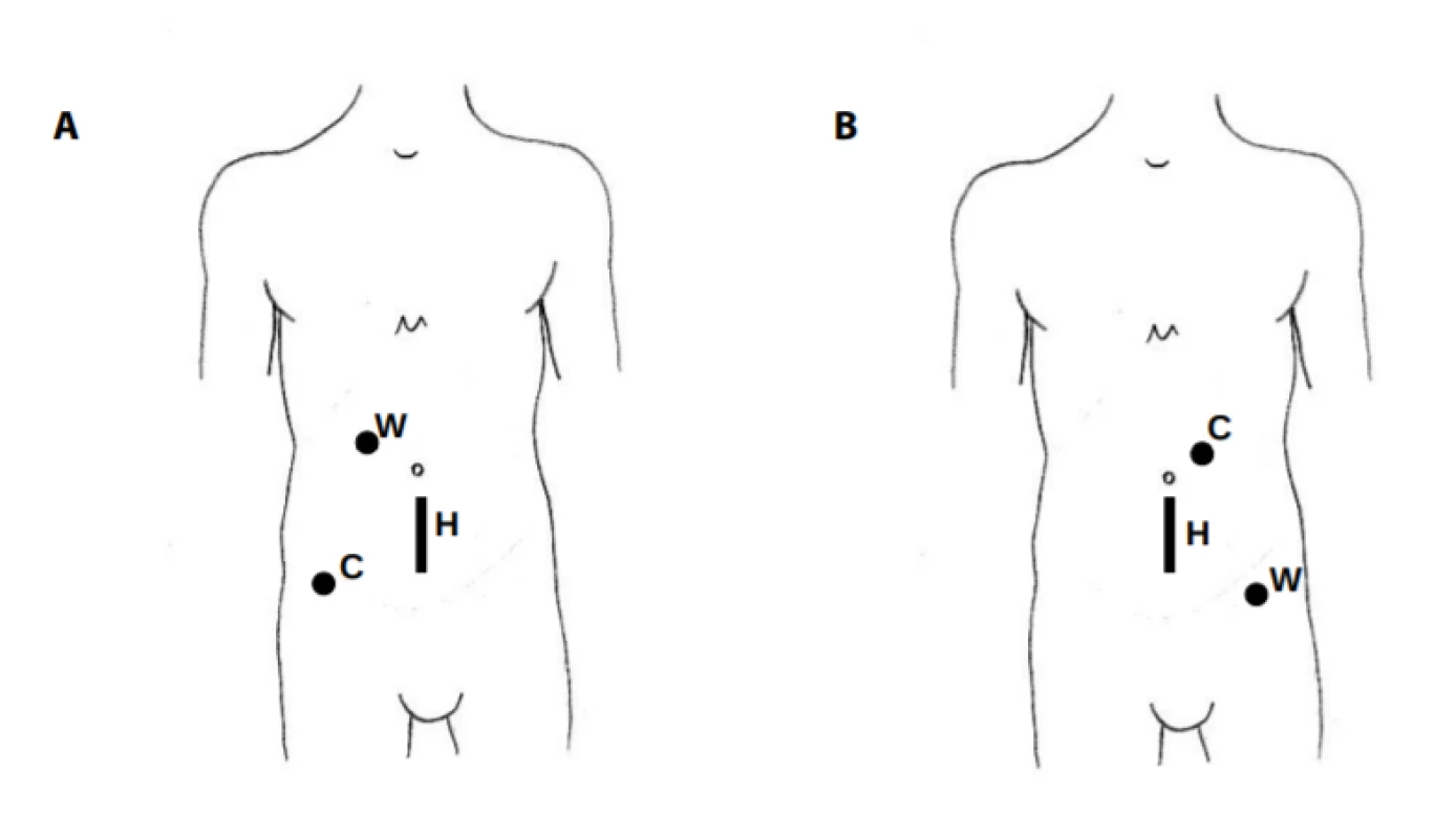 Umístění portů pro HALS nefrektomii
A − pravostranná nefrektomie; B − levostranná nefrektomie; C – kamerový port, H – hand port; W – pracovní port<br>
Fig. 3: Localisation of the ports used in HALS nephrectomy
A − right-side nephrectomy; B − left-side nephrectomy; C – camera port, H – hand port; W – working port.