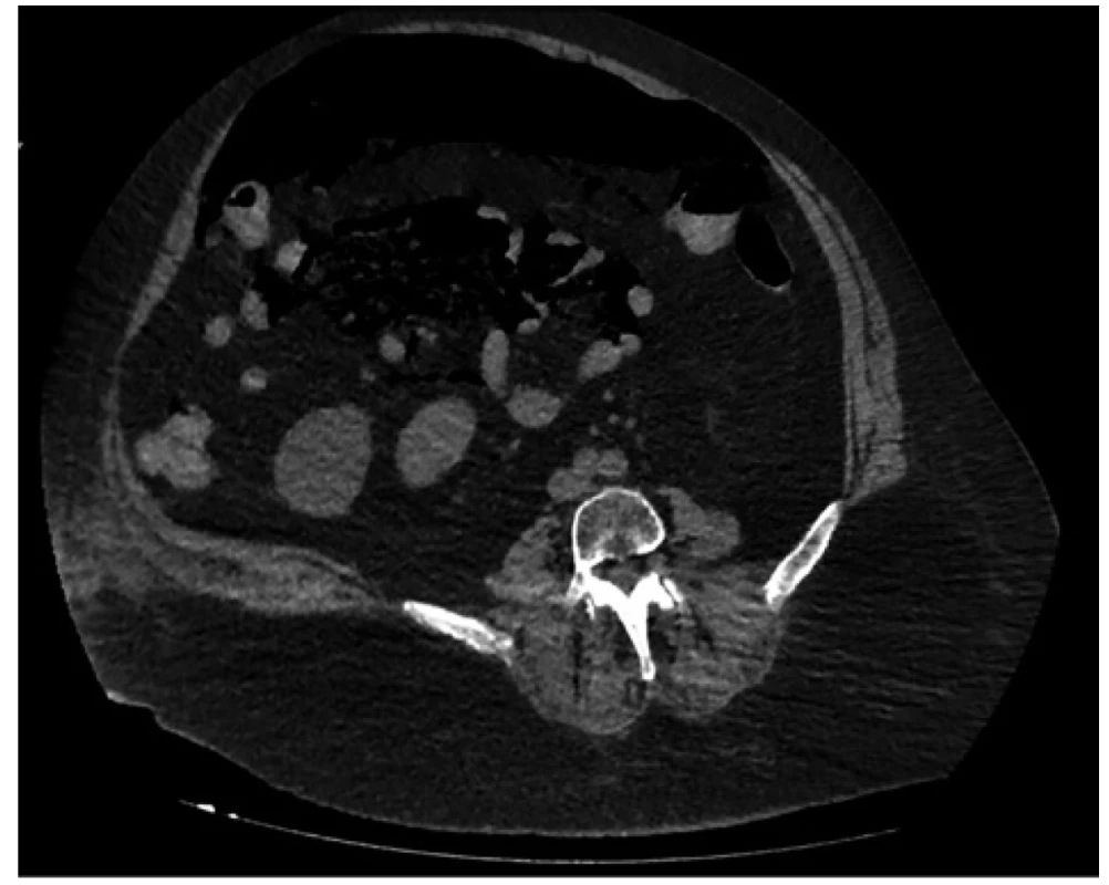 Pneumoperitoneum <br>
Fig. 2: Pneumoperitoneum