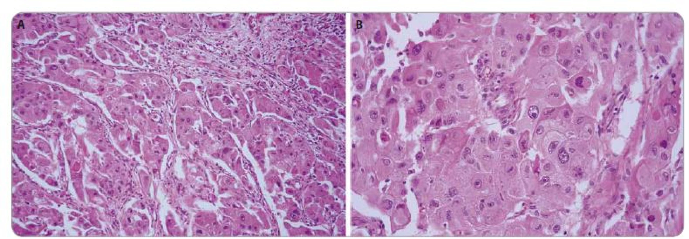 Epithelioid angiomyolipoma of the kidney.
The histological image was characterized by epithelioid morphology of tumor cells, with enlarged atypical nuclei and prominent nucleoli.
HE, 200× (A), 400× (B).