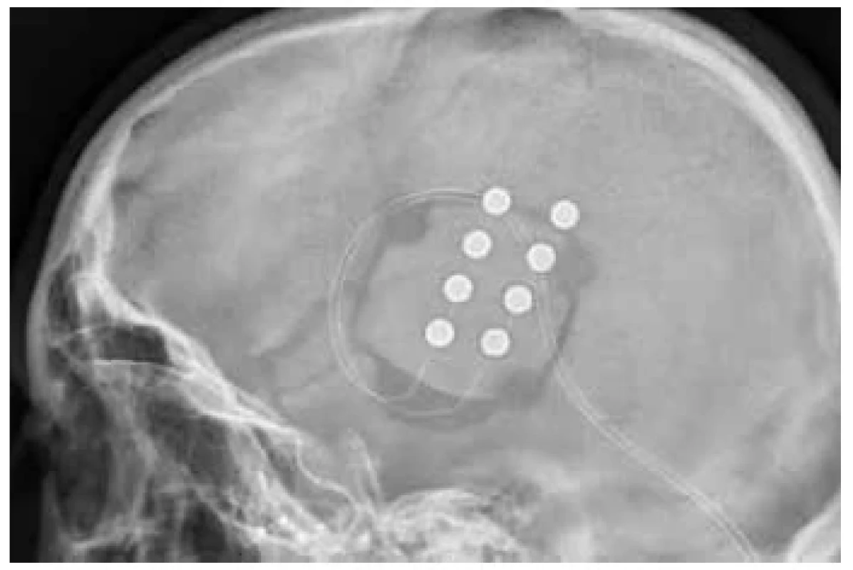 Kortikální stimulace