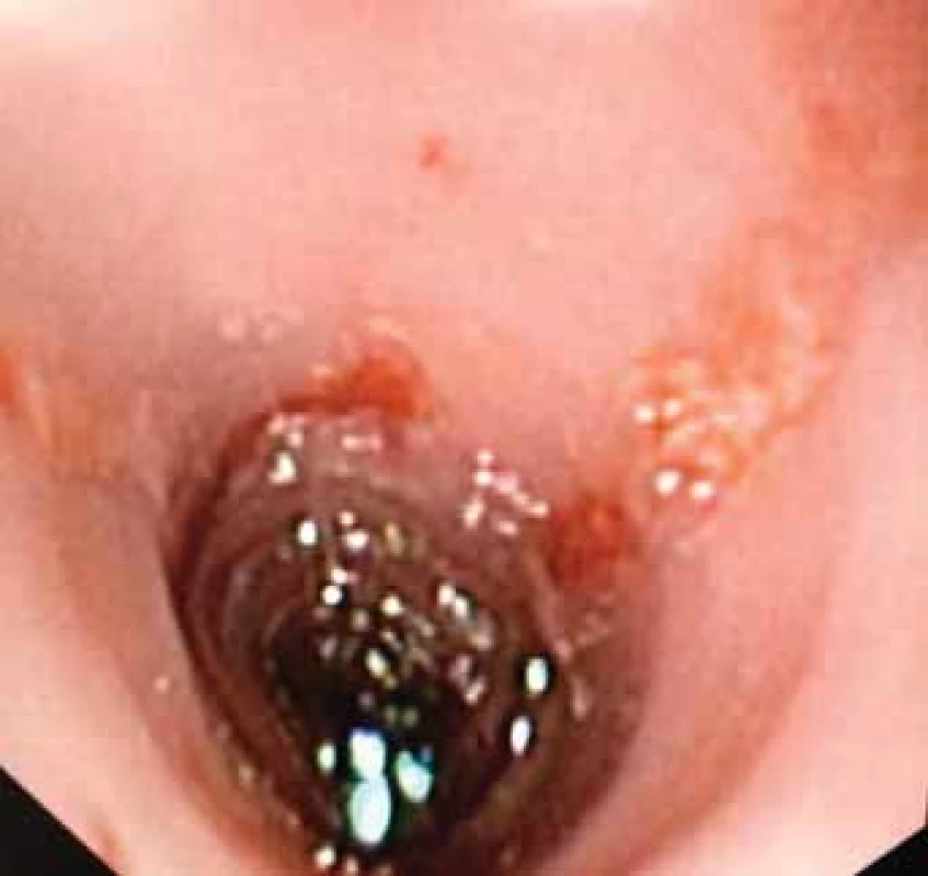 A. Endoscopic imaging – view of distal esophagus.
Ulceration covered by mucus, mucosa fragile to the touch,
contact bleeding.<br>
Obr. 1A. Endoskopický obraz – pohled na distální jícen.
Ulcerace kryté hlenem, sliznice kâehká na dotek, kontaktně
krvácející.