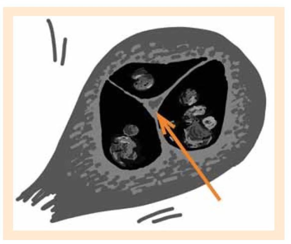 a. Zóna ypsilon, schematické znázornění ultrazvukového
nálezu (autor: Osičková V).<br>
Fig. 3a. Ypsilon zone, schematic representation of an ultrasound
finding (author: Osičková V).