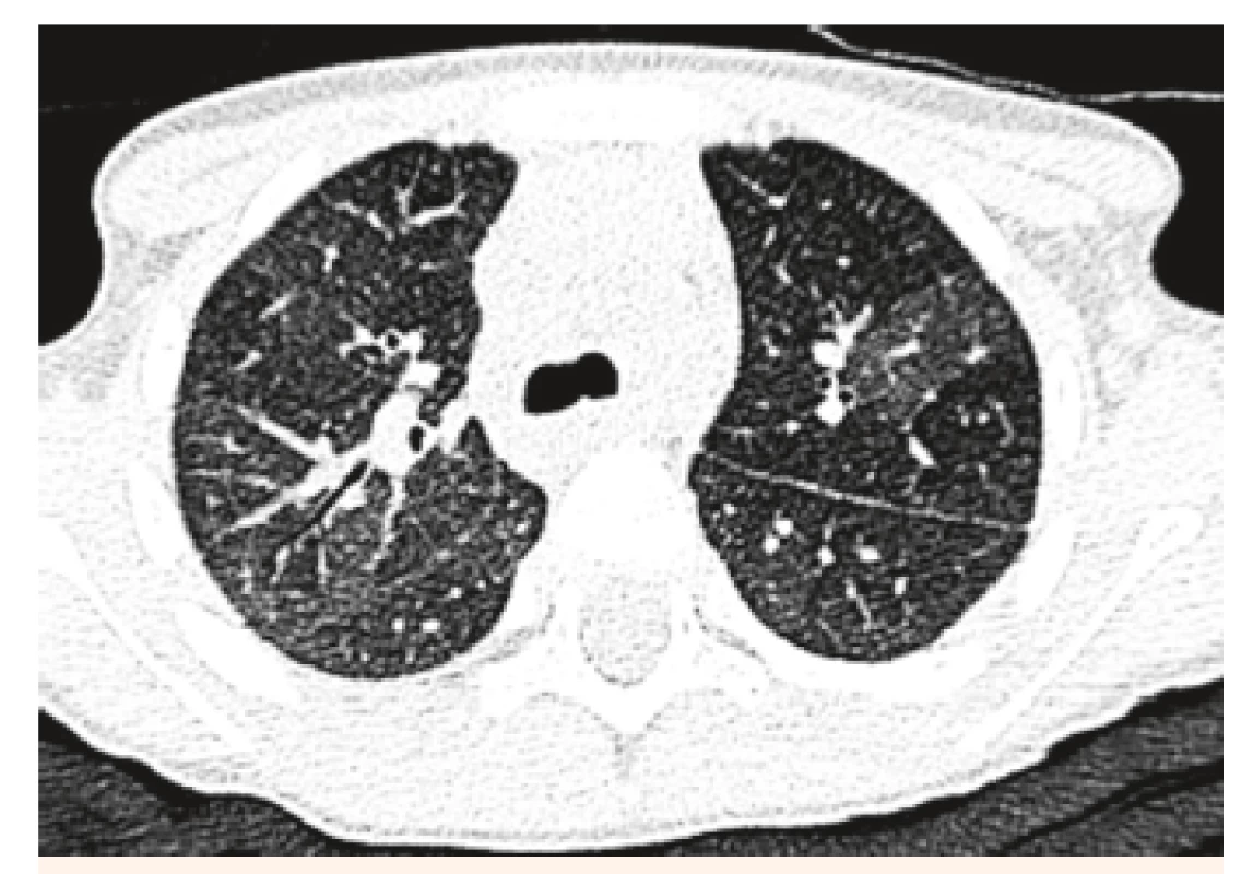 HRCT pľúc u našej 4-ročnej pacientky, mozaikovitá
perfúzia pľúc ako známka intersticiálneho postihnutia.<br>
Fig. 3. HRCT examination of lung in our 4-year patient, mosaic
lung perfusion as a sign of interstitial disability.