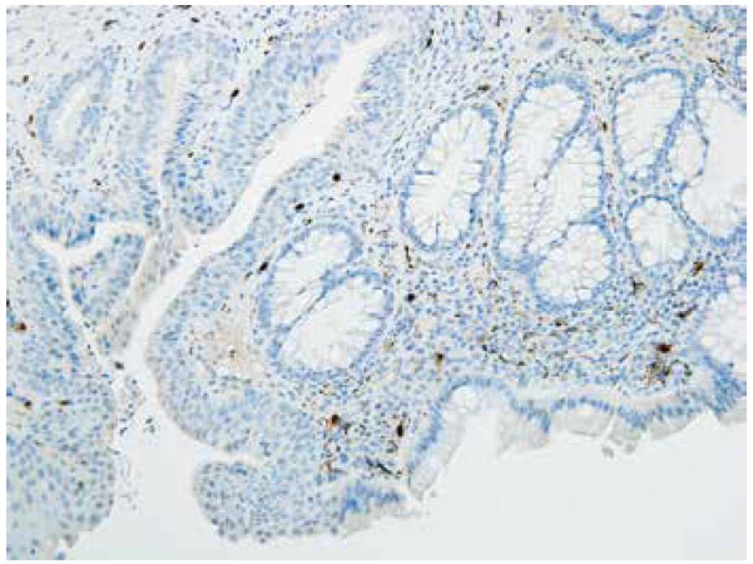 Pozitivní imunohistochemický průkaz kalretininu v anorektální junkci,
negat-HN (200x).