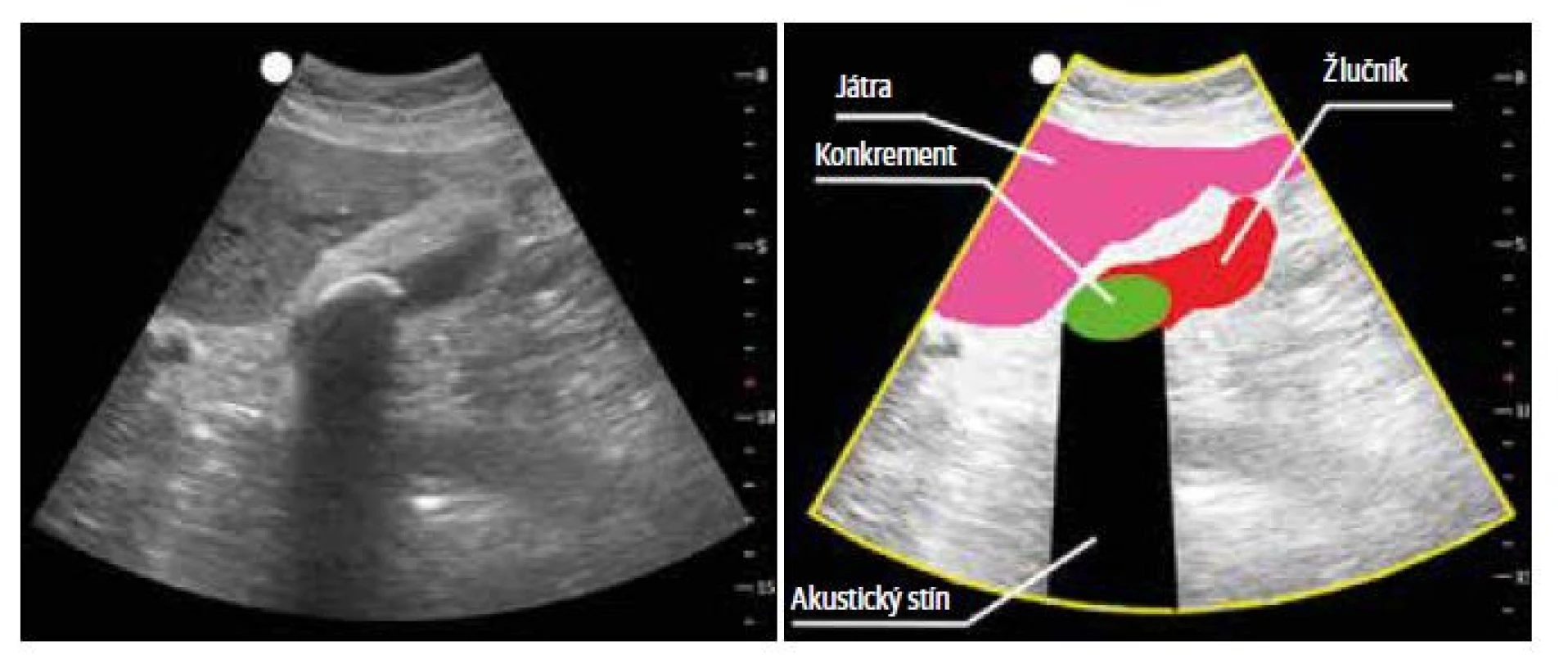 Akustický stín za konkrementem ve žlučníku. Stín vychází ze struktury konkrementu a pokračuje
do periferie obrazu. Jelikož nedochází k žádnému šíření signálu za překážku, ve stínu se již nezobrazují
žádné anatomické struktury; a) sonografický snímek, b) kresba.