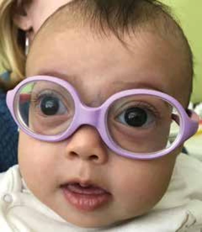 Central
facial dysmorphia,
shallow
orbits, pseudoexophthalmos,
hypertelorism
and low root of
nose in patient
with Marshall/
Stickler syndrome
at age of
15 months.