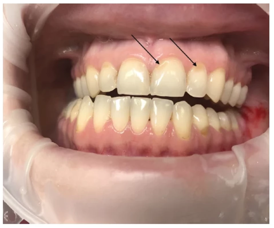 Zubní eroze – lokalizace
erozivních lézí závisí na zdroji
kyselin vyvolávajících dané
defekty (označené černou
šipkou) <br> 
Fig. 3.
Dental erosion – the location of
erosive lesions depends on the
sources of acids causing the
defects (black arrow)