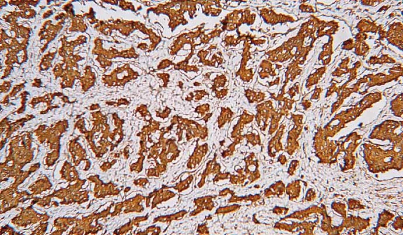 Neuroendokrinný nádor. Imunohistochemické vyšetrenie s protilátkou proti chromogranínu. Silná difúzna pozitivita. 3,3-diaminobenzidín, 200×.