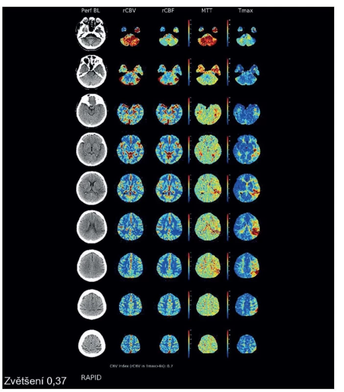 Perfuzní CT mozku prokazující významný rozdíl mezi objemem jádra infarktu a penumbrou<br>
Fig. 2: CT perfusion demonstrating a significant mismatch between the ischemic core volume and the penumbra