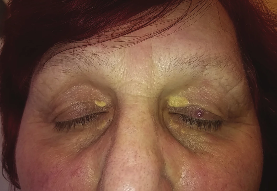 Xanthelasma palpebrarum horního i dolního víčka obou
očí (z archivu Centra preventivní kardiologie III. interní kliniky VFN
v Praze)