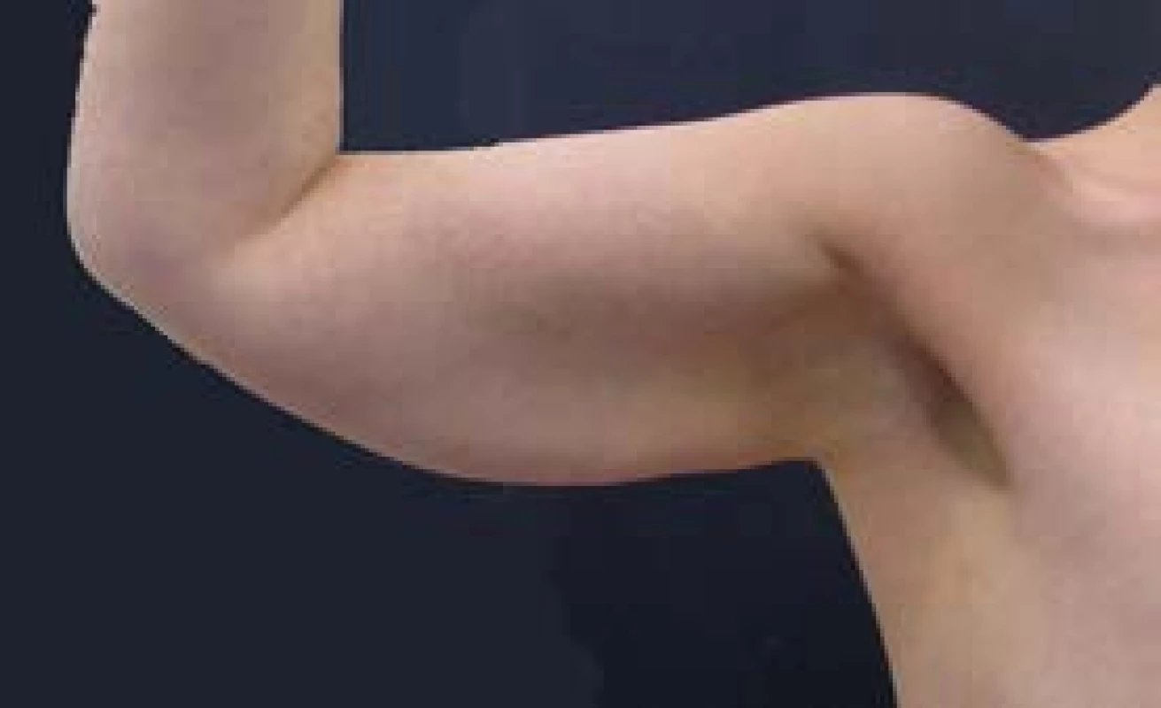 Předoperační nález u 25leté pacientky po redukci
hmotnosti o 50 kg