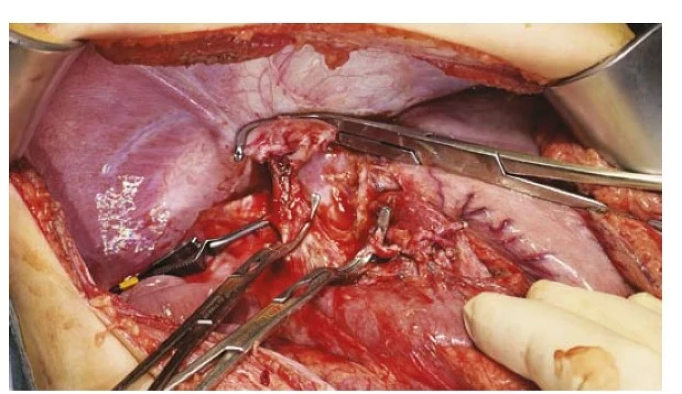 Anhepatická fáze během transplantace jater (dutina břišní
bez jater), svorky na jaterní tepně, portě, jaterních žilách