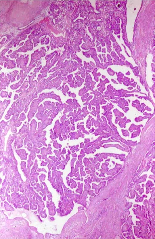 Papilární cystadenom nadvarlete u pacienta
s VHL. Barveno HE. Zvětšeno 400×<br>
Fig. 4. Papillary cystadenoma of the epididymis. Patient with a VHL syndrome. H&E. Viewed at 400× magnification
