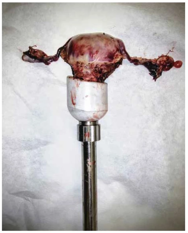 Děložní manipulátor.<br>
Fig. 1. Uterine manipulator.