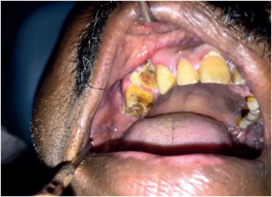 Ulceration in the alveolar mucosa with unhealed socket and denuded
bone in relation to tooth #14.