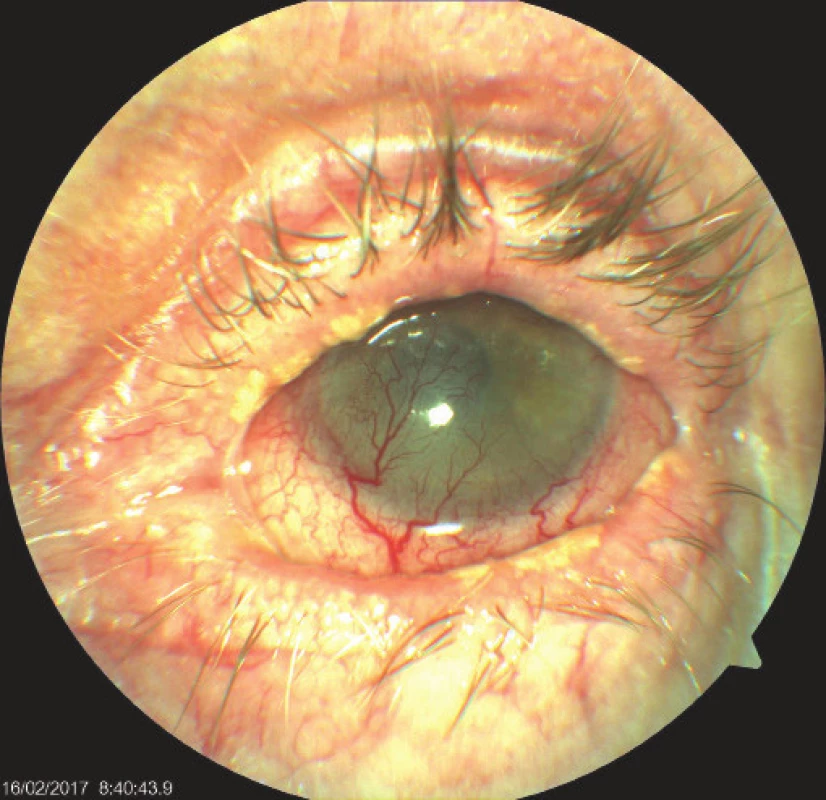 Left eye of patient with severe cicatrising blepharoconjunctivitis,
vascularised leucoma, on surface persistent
painful defect of corneal epithelium. Whitish plaques on
edges of eyelid suggestive of lichenoid lesions