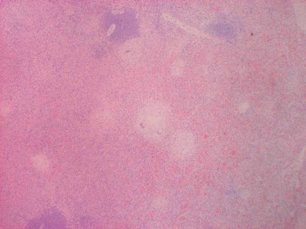 Histologický preparát sleziny. Barvení H+E, zvětšení 20×.
V červené pulpě centrálně a vlevo granulomy s popraškovou nekrózou,
vpravo a nahoře bílá pulpa. 