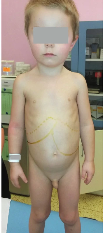Hepatosplenomegalie
u 3,5letého chlapce
s Gaucherovou nemocí
typu I.<br>
Fig. 4. Hepatosplenomegaly in
3.5-year-old child with
Gaucher disease Type I.