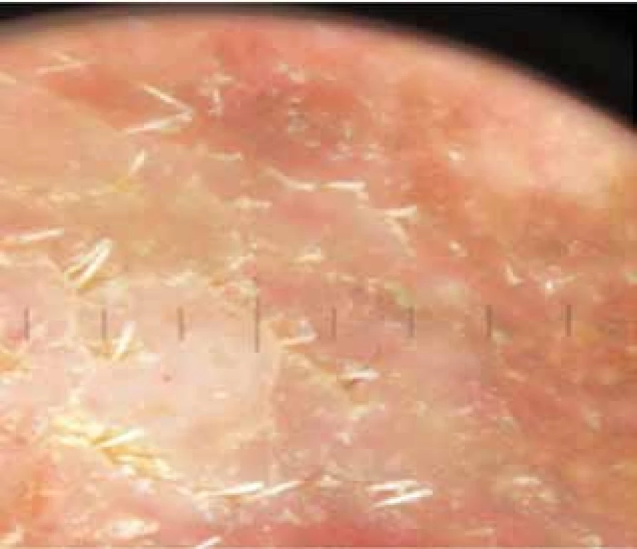 Dermatoskopický obraz světlejšího útvaru pod bradou –
šupící povrch, v horní a pravé části obrázku drobné hnědé tečky
a globule, tečkovité cévy v horní a dolní části