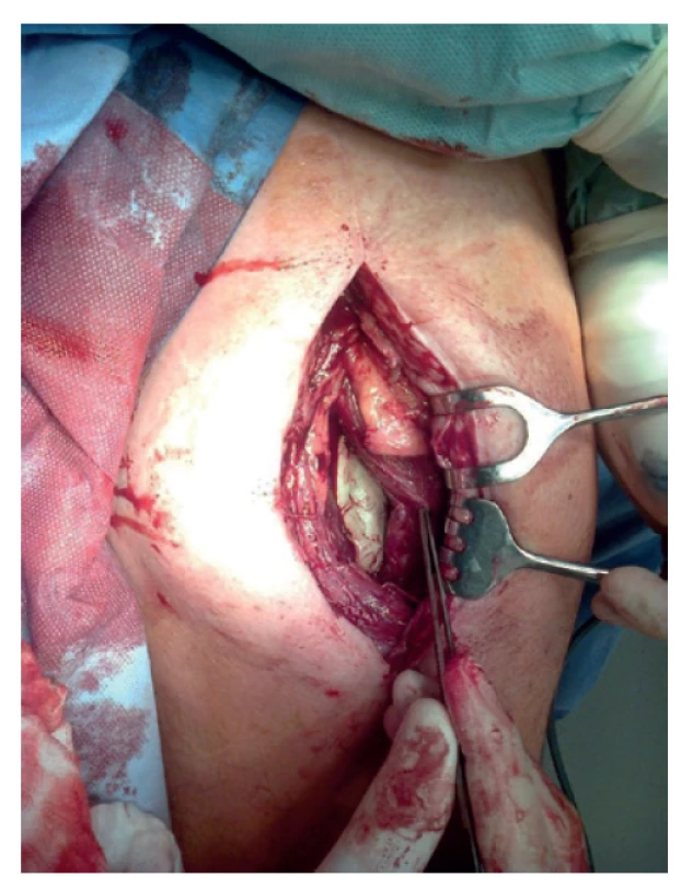 Polymethylmetakrylátový spacer umístěný v oblasti
kostního defektu<br>
Fig. 1: Polymethylmethacrylate spacer inserted into the
bone defect