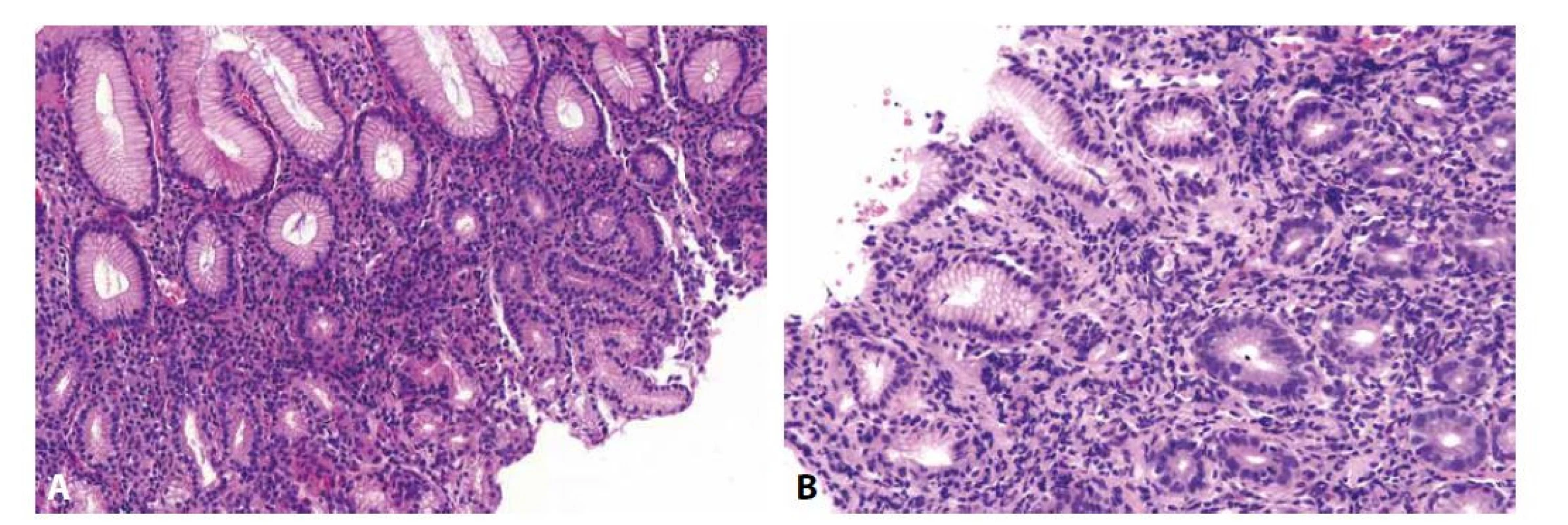 Helicobacterová gastritida