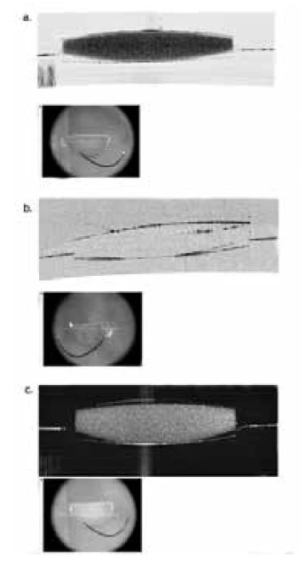 Řezy pomocí předněsegmentového OCT in vitro
– a. homogenní rozptyl světla (tzv. scattering efekt) na
explantované NOČ, b. vymizení rozptylu světla na vysušené
NOČ a c. rozptyl světla na opětovně rehydratované
NOČ, co dokazuje, že se jedná o hydrofilní materiál