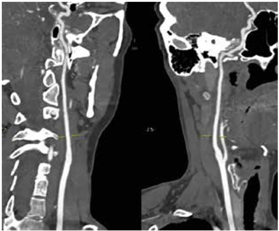 CTAg obraz ACI sin. po 3 měsících v předozadní a bočné projekci <br>
Fig. 6. CTAg image of ACI sin. after 3 months in anterior-posterior and lateral projections
