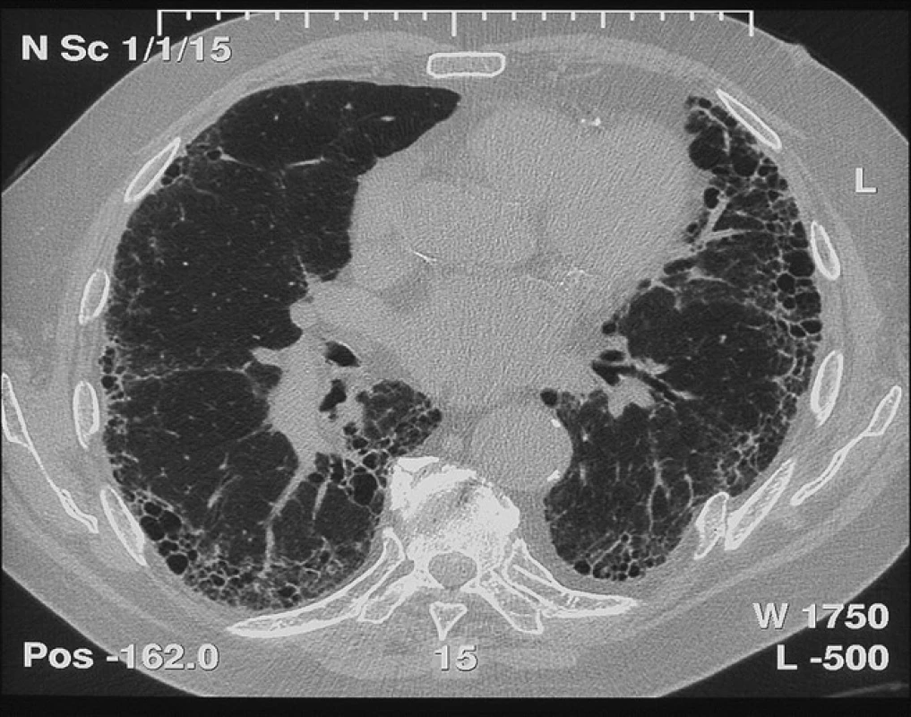 Radiologický obraz definitivní UIP s voštinovitou plící