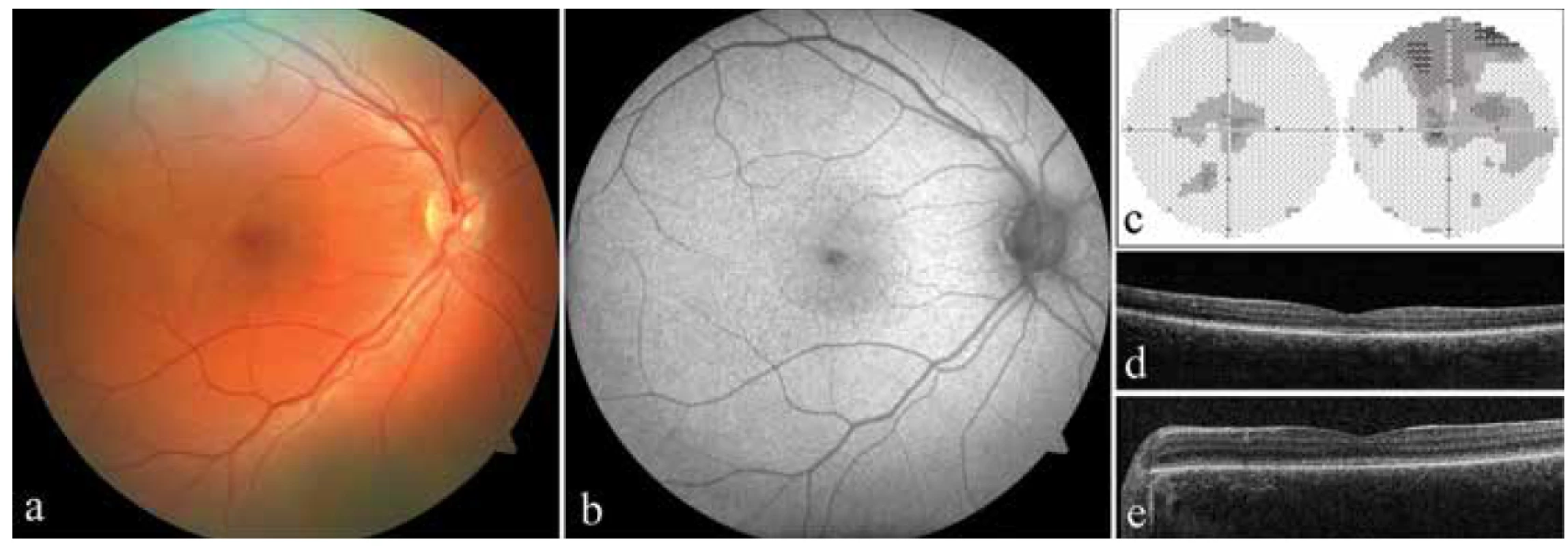 Klinický nález u obou probandů s achromatopsií. a) fotografie fundu pravého oka probanda 1, b) autofluorescence
fundu pravého oka probanda 1, c) perimetr pravého a levého oka probanda 1, d) optická koherenční tomografie se
spektrální doménou (SD-OCT) levého oka probanda 1, e) SD-OCT levého oka probanda 2