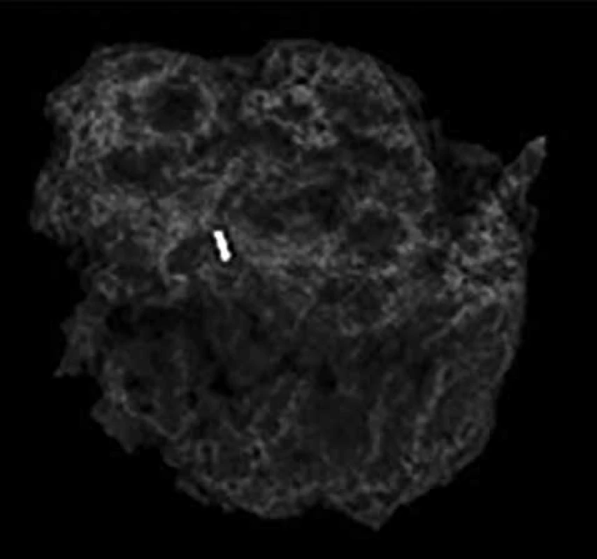 Resekát prsu ident. klipem <br>Fig. 3: Resected breast tissue with the ident. clip
