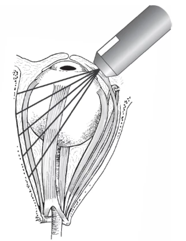 B-scan of musculus rectus in transverse image – the
muscle is shown in cross-section as a round slice of hypoechoic
structure in the orbital echogram