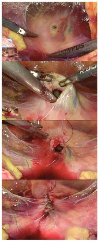 Laparoskopické ošetření poranění močového
měchýře po endoskopickém výkonu <br> 
Fig. 4. Laparoscopic treatment of bladder injury after
endoscopic surgery