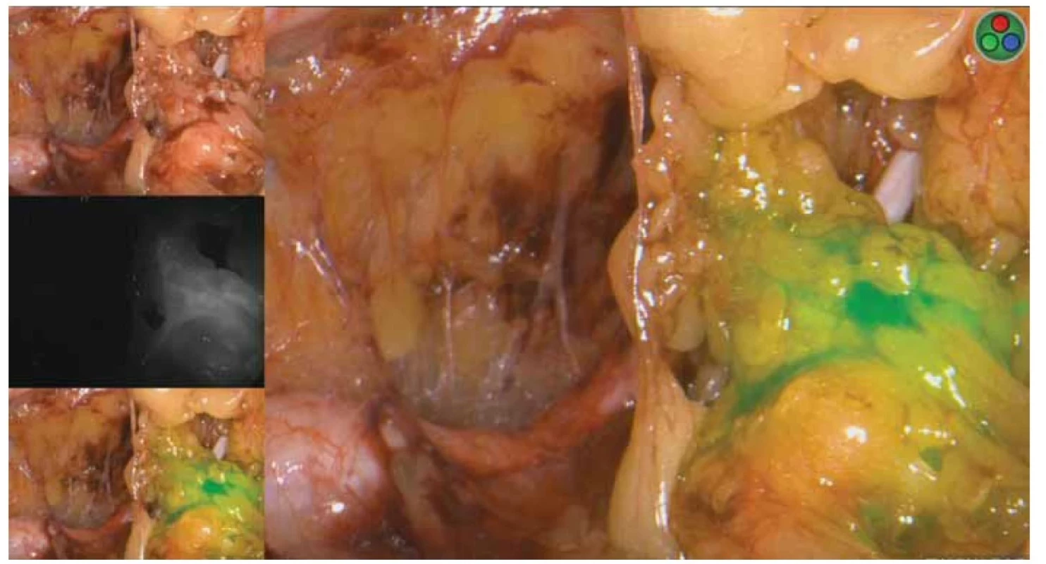 Sentinelová lymfatická uzlina v supraobturátorové oblasti – Novadaq Pinpoint Fluorescence Mode.<br>
Fig. 2. Sentinel lymph nodes in the supraobturator region – Novadaq Pinpoint Fluorescence Mode.