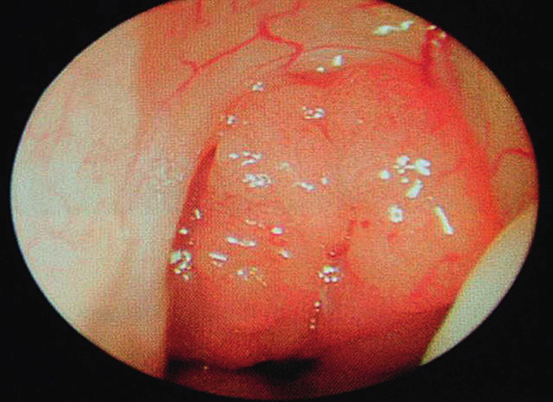 Facies adenoidea.