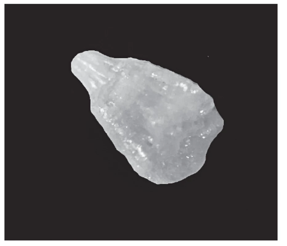 Fragment of analyzed renal stone (dimensions 2 x 1
millimeter)